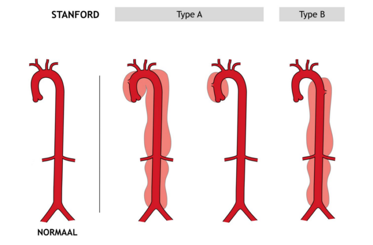 aortadissectie